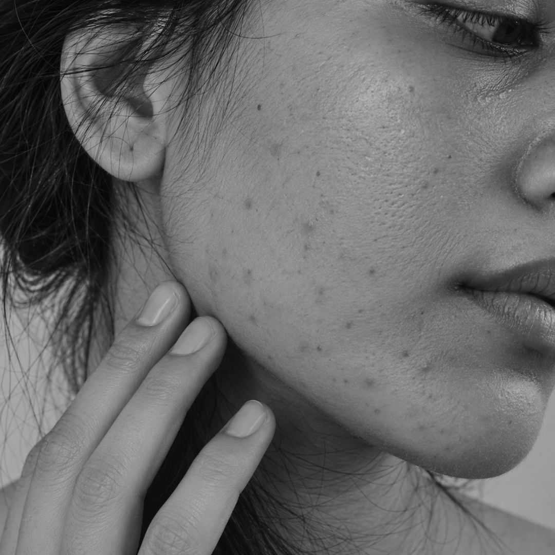 Acne — Ayurvedic skin care from Ayurveda Amrita