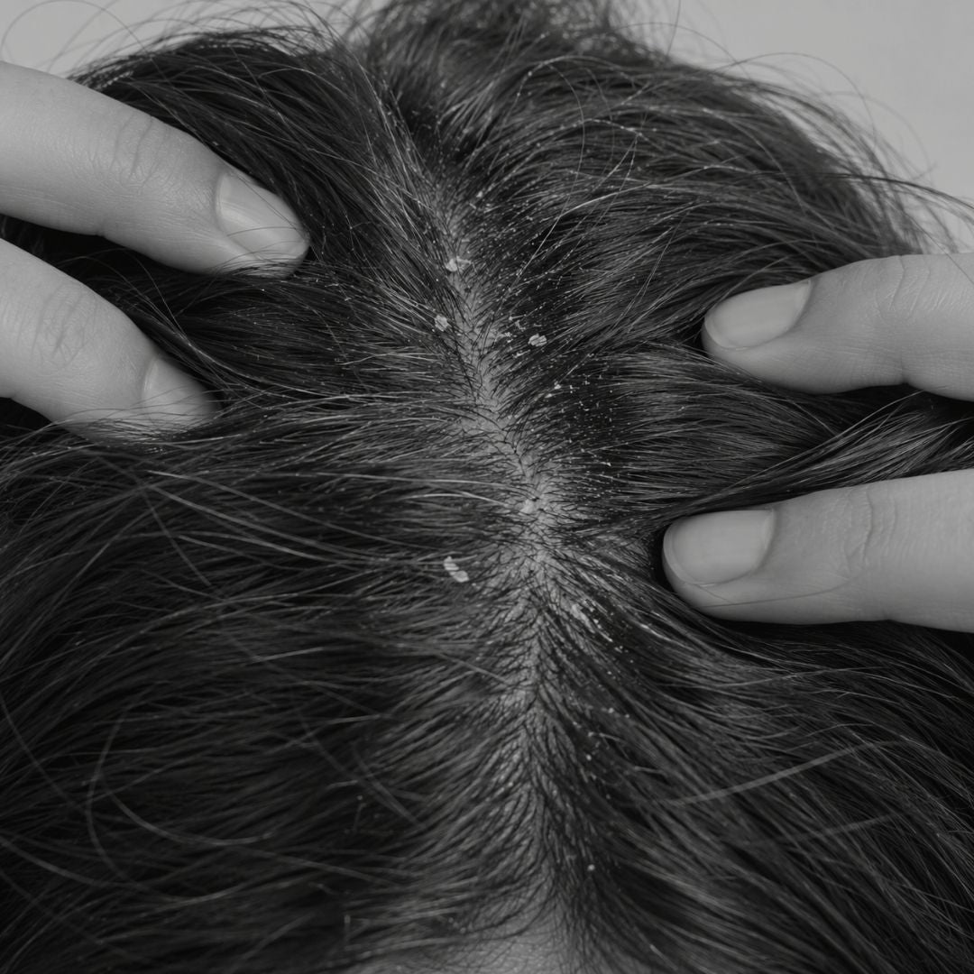 Dandruff — Ayurvedic scalp care from Ayurveda Amrita